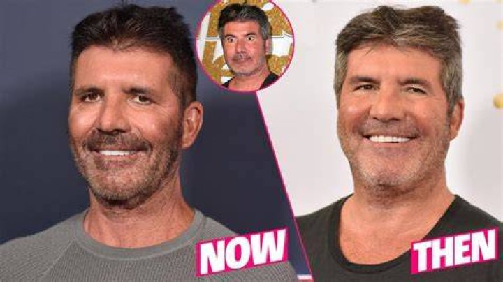 
Simon Cowell Before And After Looks: The X Factor Creator Went Too Far With The Plastic Surgery 